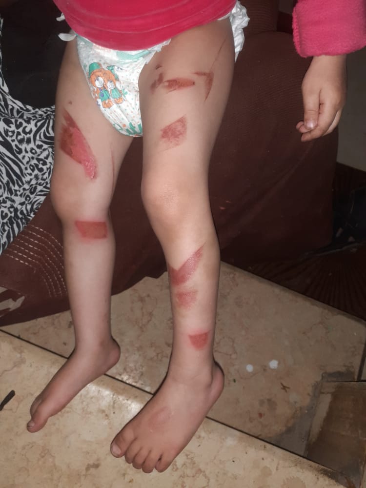 آثار التعذيب على جسد طفلة الفيوم 