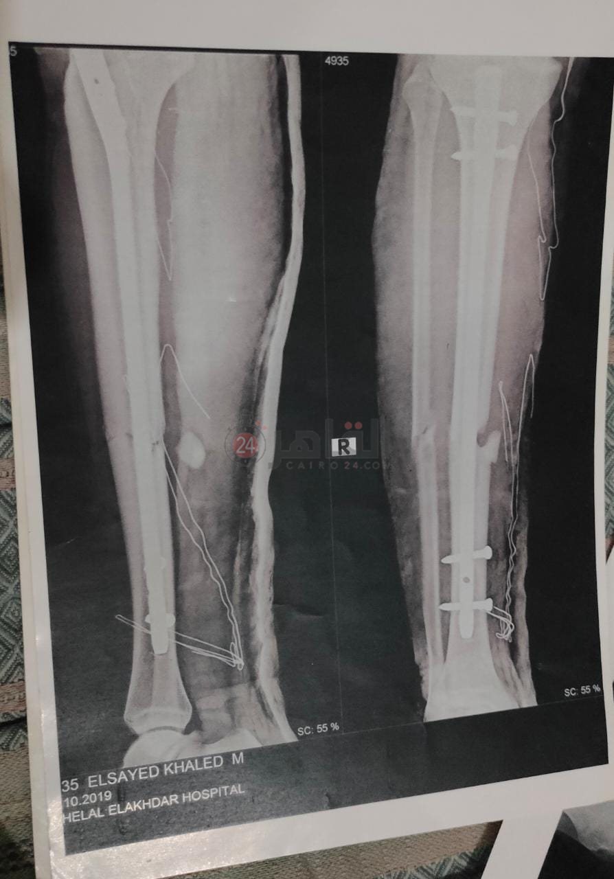 آشعة على ساق اللاعب فور الإصابة 01