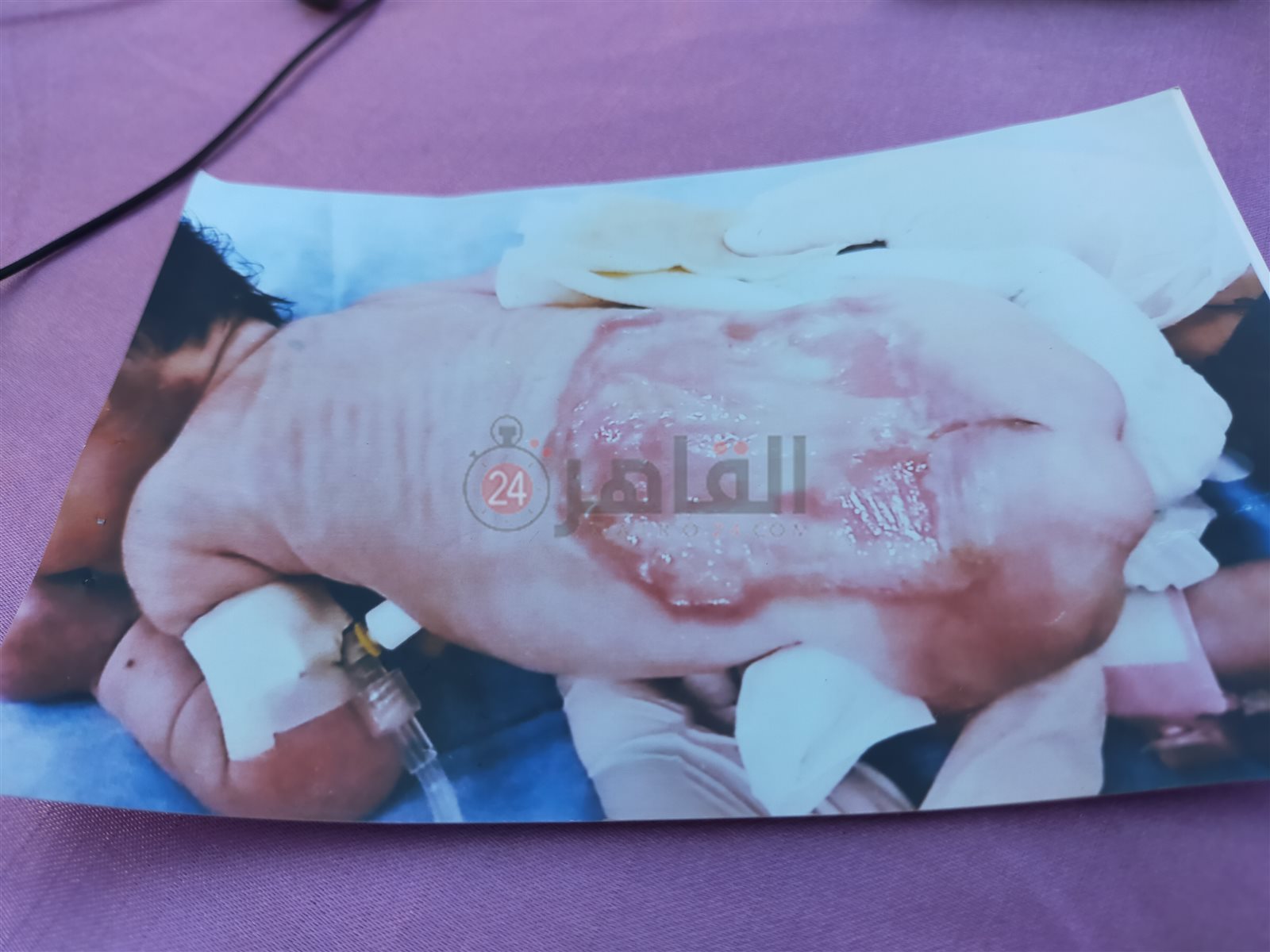 الطفلة المصابة رقية فرغلي