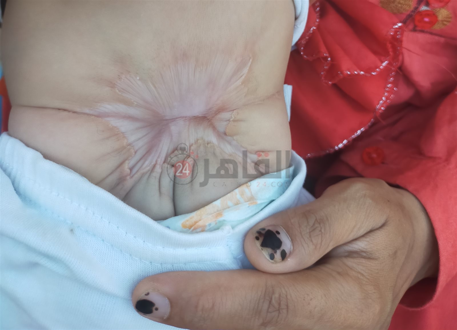 الحالة الصحية الحالية للطفلة رقية