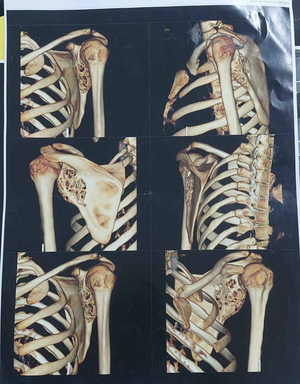 استئصال ورم سرطاني متشعب لطفلة بالشرقية 01