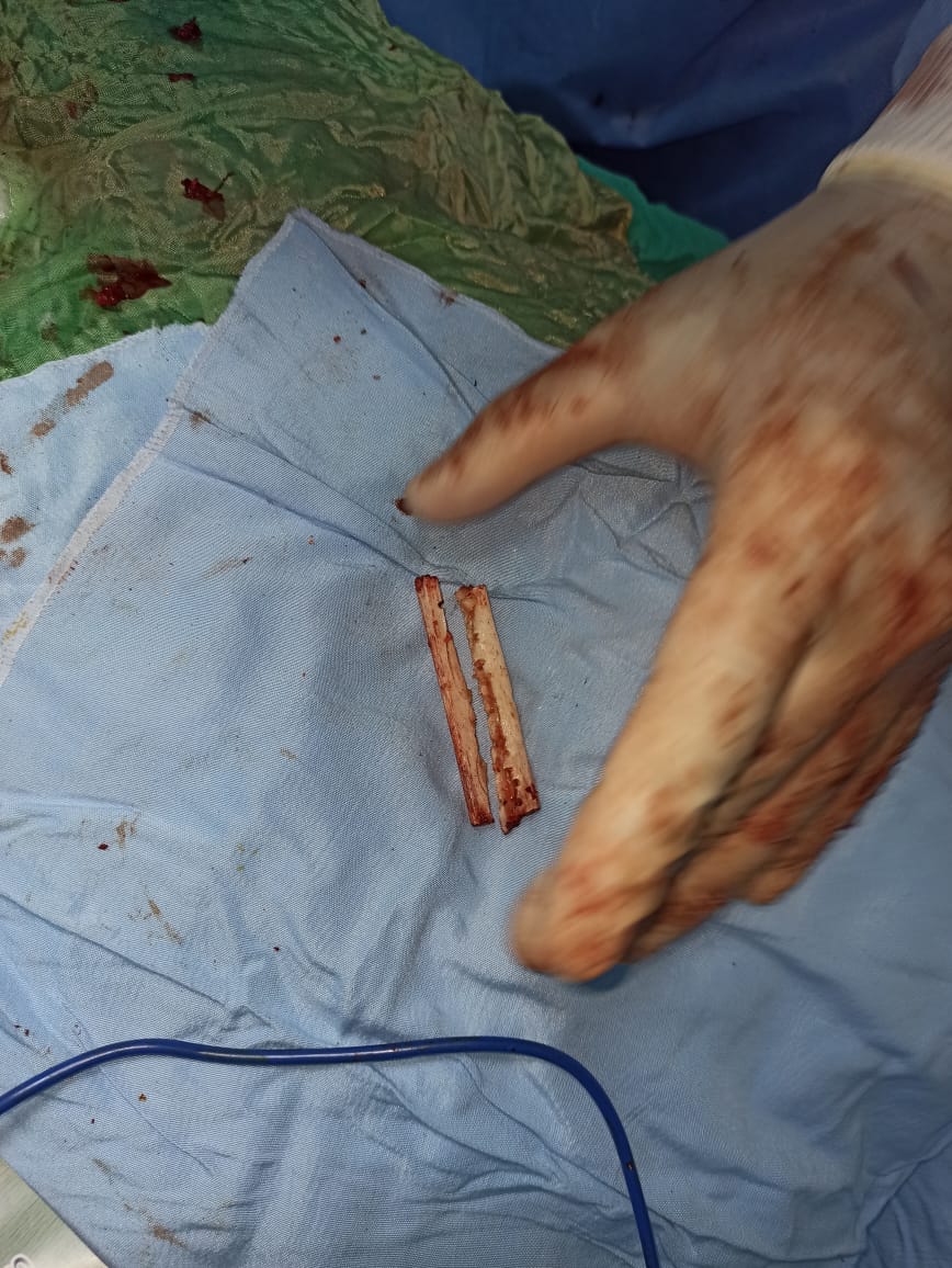 استئصال ورم سرطاني متشعب لطفلة بالشرقية 02