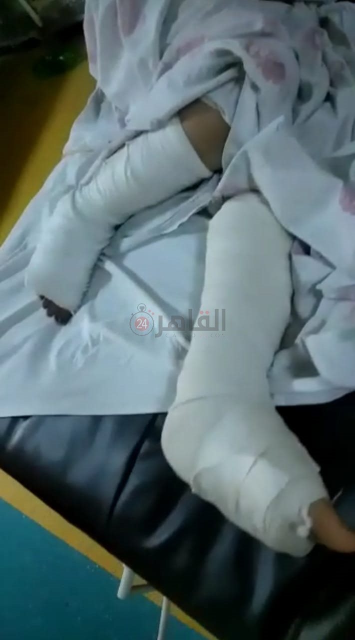 سقوط المجني عليها تسبب في كسر وكدمات بقدميها