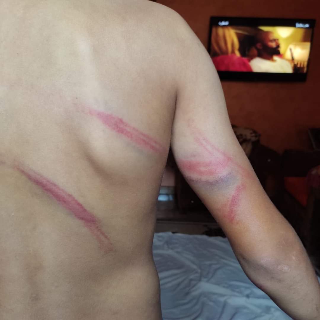 أثار التعذيب على جسد الطفل 3