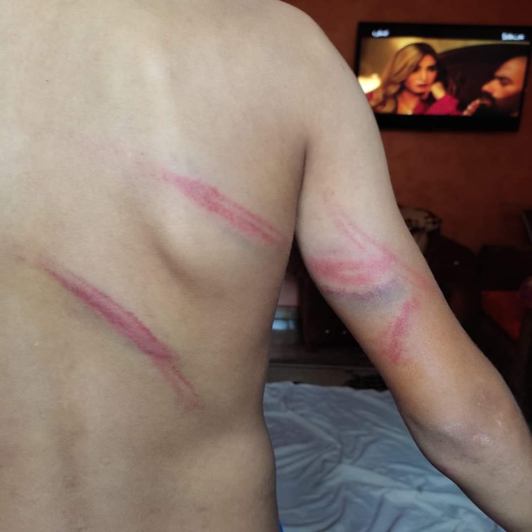 أثار التعذيب على جسد الطفل 4