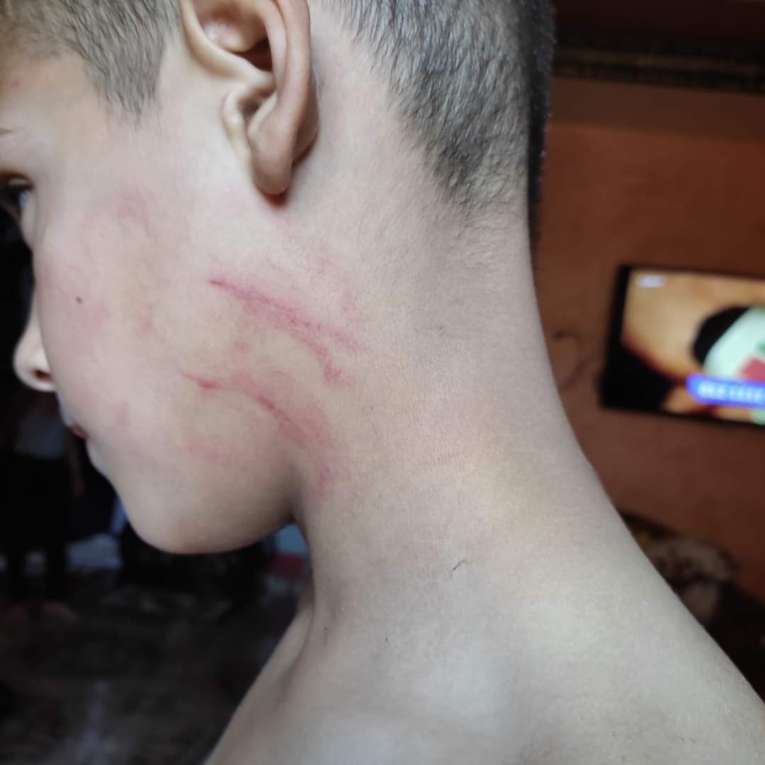 أثار التعذيب على جسد الطفل 5