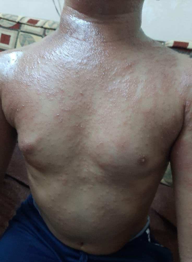 تعرض مواطنين للسعات قنديل البحر 