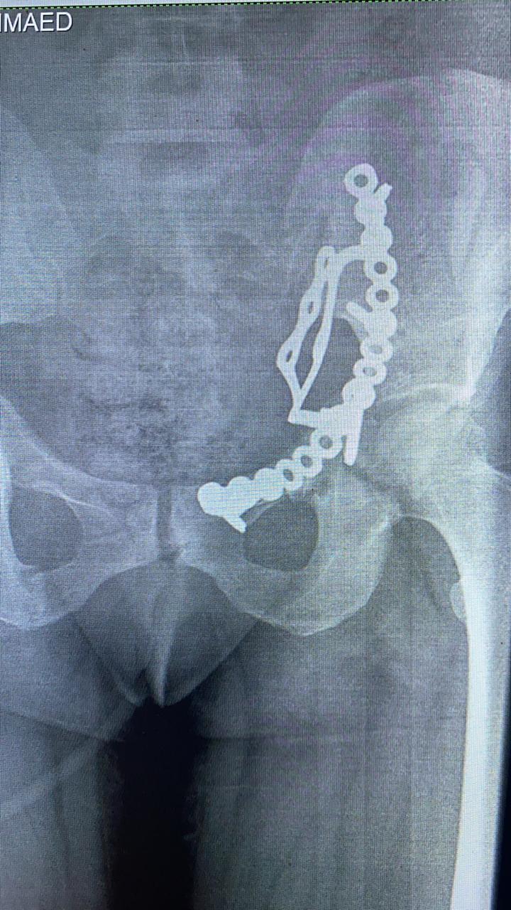 إجراء عملية إصلاح كسور متعددة مفتتة بالحوض لأول مرة بالشرقية 01