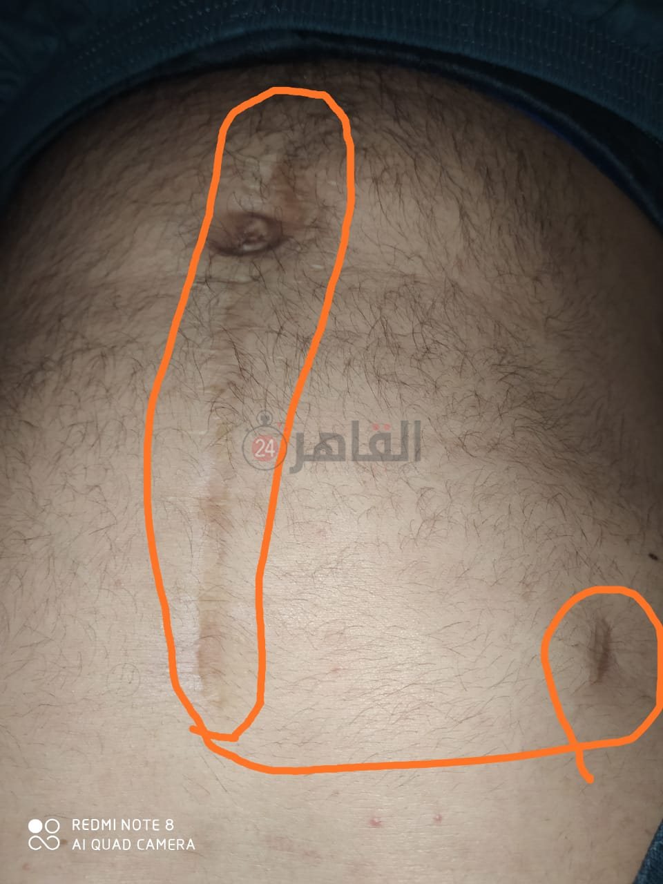 آثار العاهة المستديمة في بطن المجني عليه 01