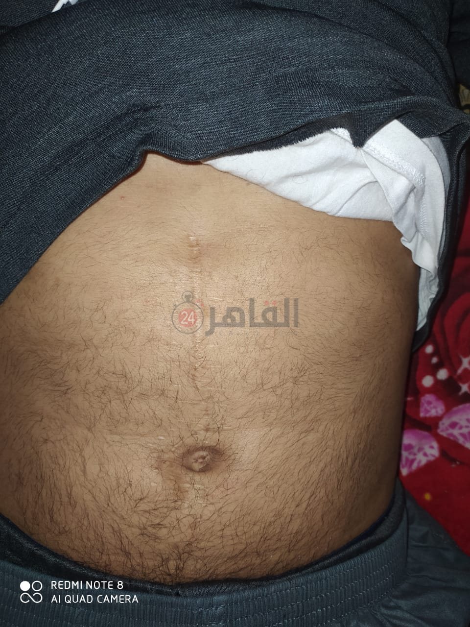 آثار العاهة المستديمة في بطن المجني عليه 02