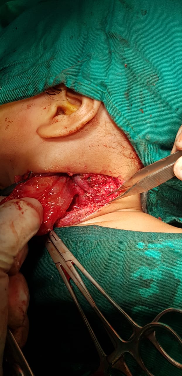 استئصال ورم من وجه طفل بالإسكندرية