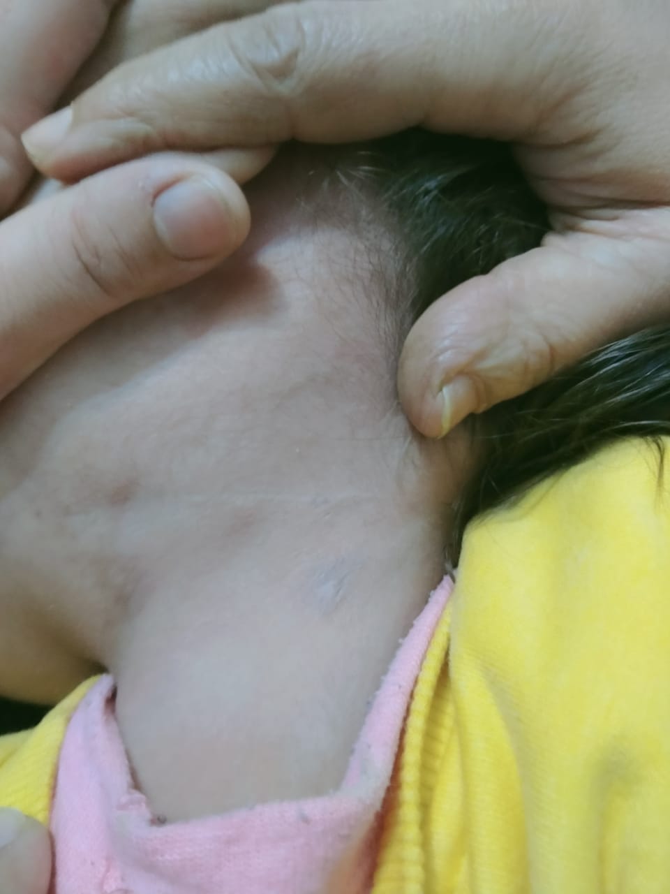 استئصال ورم من وجه طفل بالإسكندرية