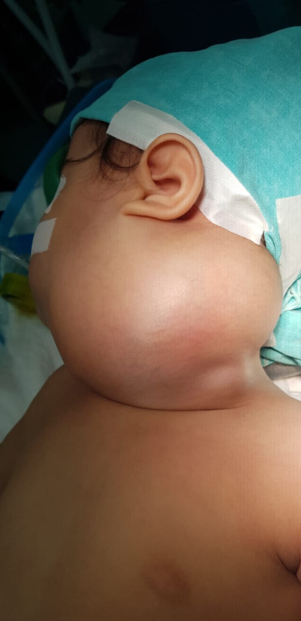 استئصال ورم من وجه طفل بالإسكندرية