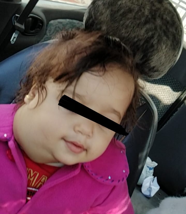 استئصال ورم من وجه طفل بالإسكندرية