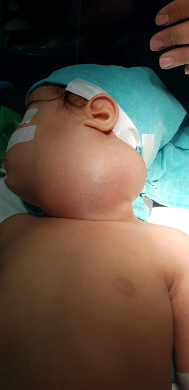 استئصال ورم من وجه طفل بالإسكندرية