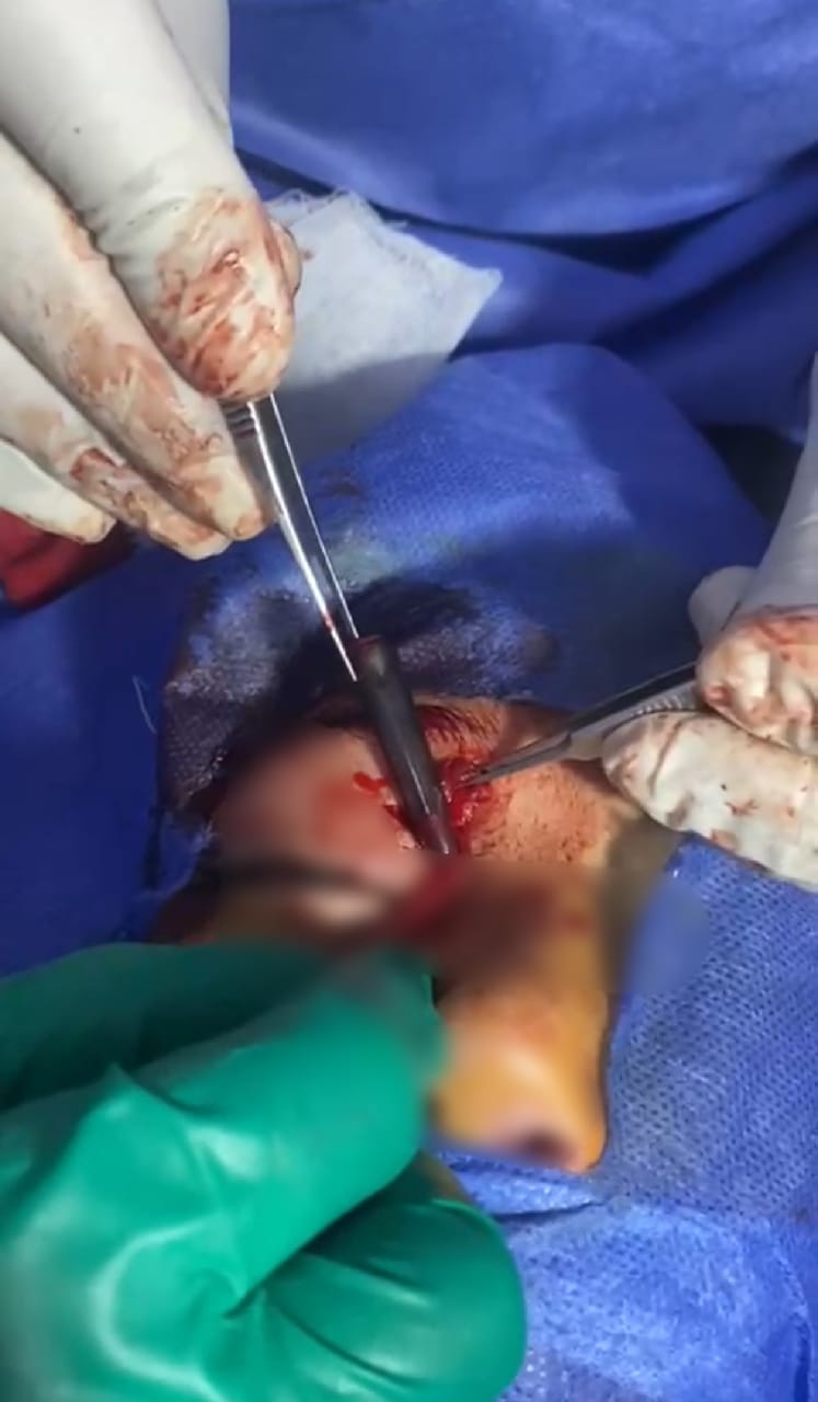 استخراج قلم جاف من عين مريض بالشرقية