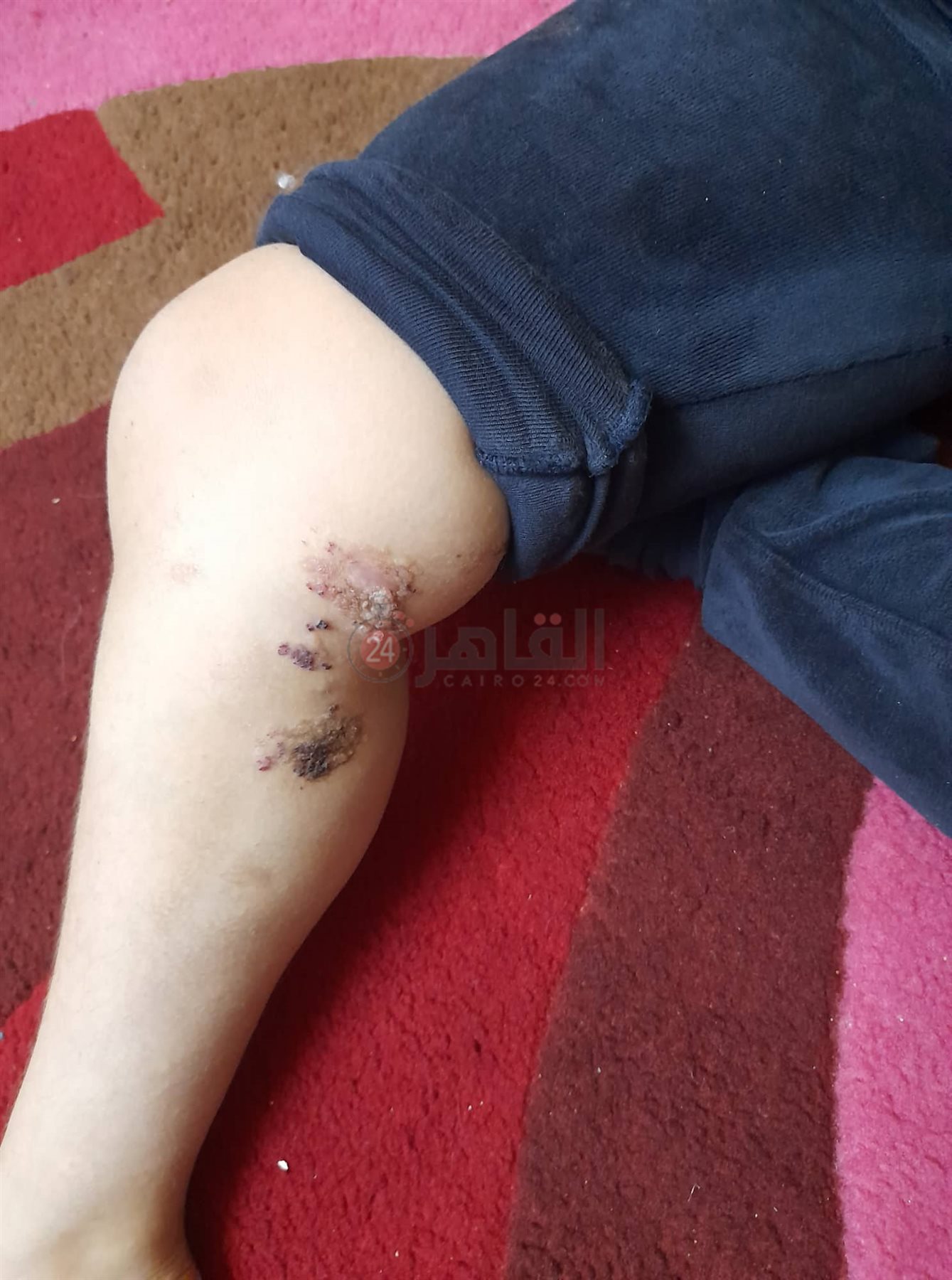 ساق الطفلة روفيدة