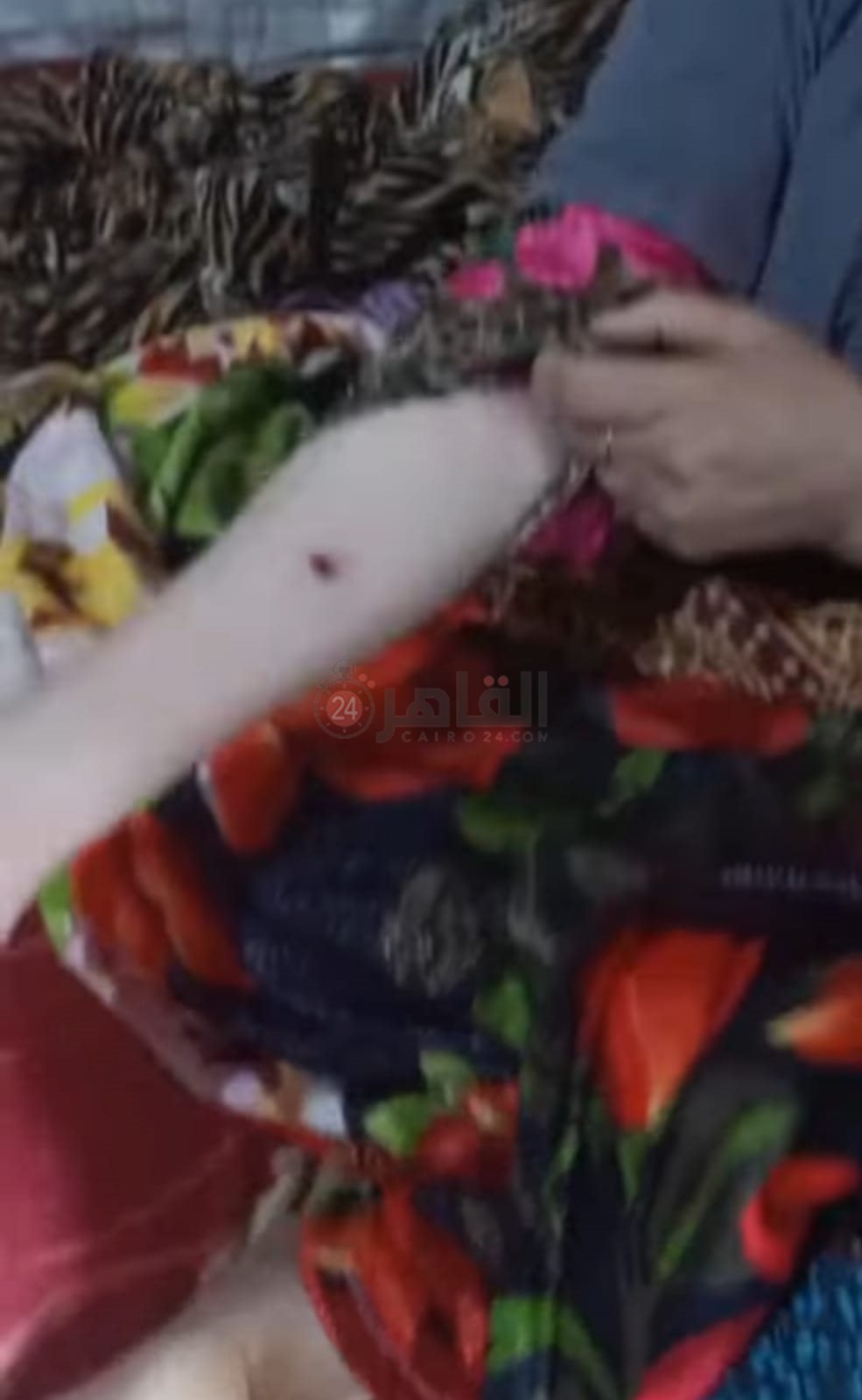 آثار عقر الكلب في يد المصابة