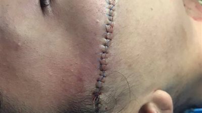 المتهم بتشويه وجه فتاة المول: “كانت بتجيلى تحت البيت مع أصحابها وتقولى يا متحرش”