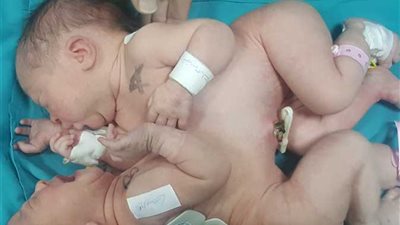 نجاح عملية فصل توأم ملتصق بمستشفى الشاطبي (صور)
