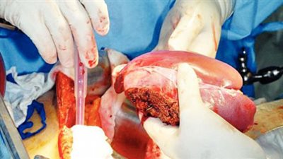 استياء كبير بين الأطباء بعد إعلان الرقابة الإدارية بشأن سرقة الأعضاء (فيديو)