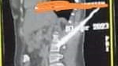 طعنها زوجها.. تفاصيل إجراء جراحة لاستخراج سكين من ظهر سيدة بقصر العيني 