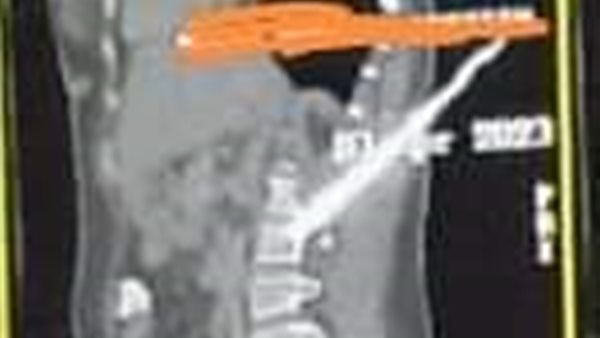 استخراج سكين من ظهر