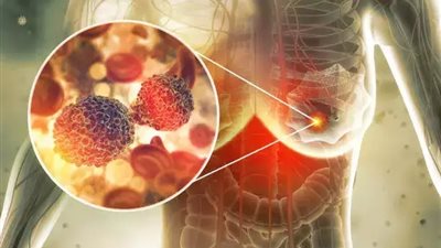 زرع بطارية.. علماء يطورون تقنية جديدة لعلاج ورم الثدي في أسبوعين