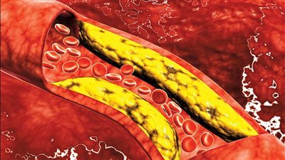 نصائح غذائية لمرضى الكوليسترول.. تعرف عليها