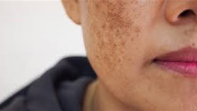 4 أشياء يجب أن تعرفيها إذا كنتِ تعانين من الكلف