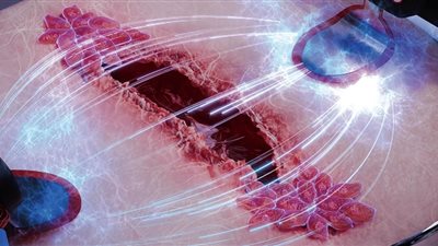 علماء يستخدمون الكهرباء للمساعدة في التئام الجروح بشكل أسرع