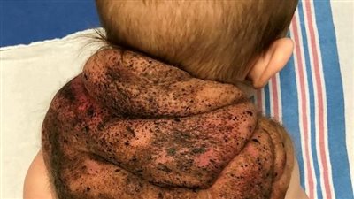 في حالة نادرة.. طفل تتشكل على ظهره كتلة غريبة تشبه صدفة السلحفاة