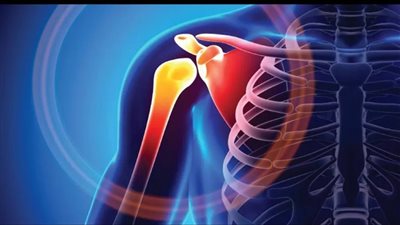 تمزق العضلات والأربطة.. مضاعفات الإصابة بخلع الكتف