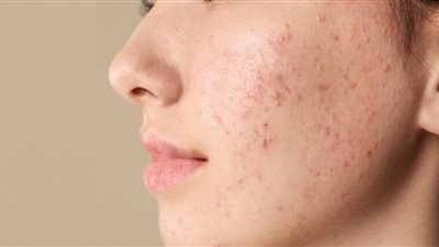 طبيبة: حب الشباب قد يكون علامة على الإصابة بالسرطان │تفاصيل