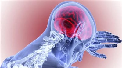 ارتفاع خطر الإصابة بالسكتة الدماغية بنسبة 50% في جميع أنحاء العالم