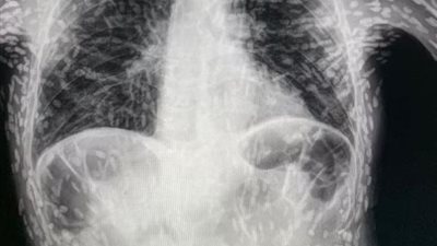 للحد من خطورتها.. باحثون سعوديون يطورون تقنية جديدة تستخدم جرعات أقل من الأشعة السينية