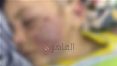 كدمات بالجسم وكسور بالساعدين.. القبض على أم وزوجها لتعذيبهما ابنتها في المحلة