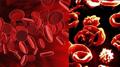 تعرف على طرق الكشف عن الإصابة بمرض الثلاسيميا 