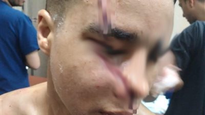 تدخل لفض مشاجرة.. إصابة طالب بـ 35 غرزة في وجهه بالإسماعيلية