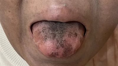 سواد اللسان.. مرض نادر يصيب عجوزًا بعد تناول المضاد الحيوي