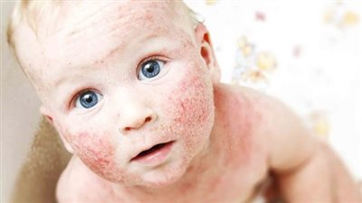 أبرزها جفاف الجلد.. تعرف على أعراض الإصابة بـ التهاب الجلد التأتبي