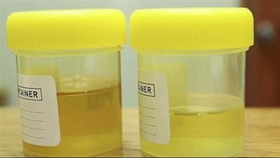 علاج صديد البول الشديد بالأدوية والفوار والأعشاب.. مدة العلاج وعلامات الشفاء