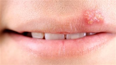 الأعراض الفموية الشائعة التي يمكن أن تشير إلى سرطان الفم