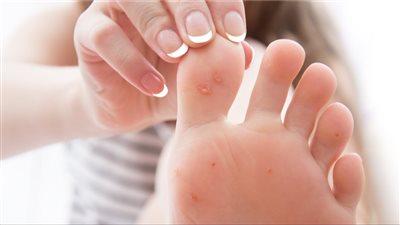 علاج مسمار القدم في المنزل بـ 7 طرق فعالة في تليين الجلد