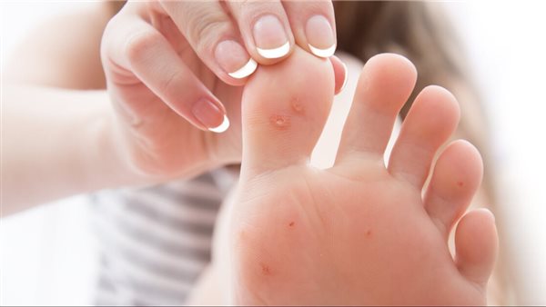 علاج مسمار القدم