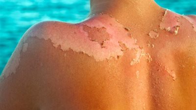 علاج حروق الشمس.. احذر منتجات تنتهي بـ كايين