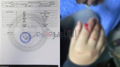مركز طبي غير مرخص يجري جراحة خاطئة لإصبع فتاة بـ 40 ألف جنيه.. ووالدها: عايشة في ألم كل يوم