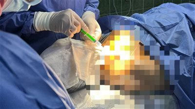 تركيب أول قسطرة مستديمة لمريض غسيل كلوي بمستشفى المحمودية المركزي بالبحيرة