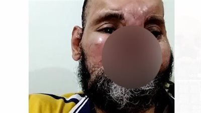 مواطن فقد أنفه والفك العلوي من الفم يستغيث: بتنفس بصعوبة.. وعايز عملية بـ30 مليون جنيه