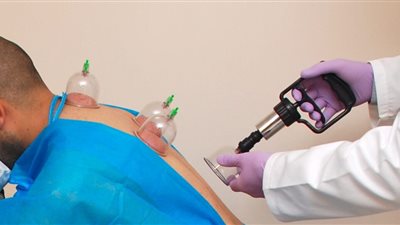 طبيب شهير يتعرض لتهديدات بالقتل بسبب الحجامة │فيديو